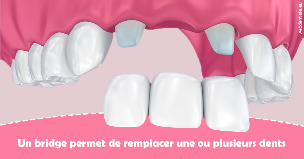 https://selarl-docteur-daniel-benichou.chirurgiens-dentistes.fr/Bridge remplacer dents 2