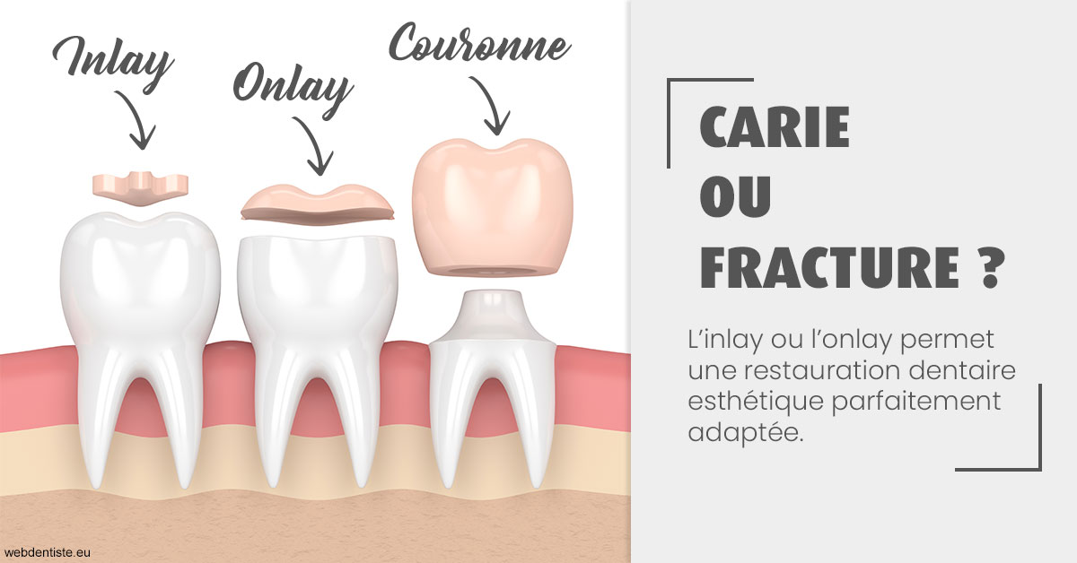 https://selarl-docteur-daniel-benichou.chirurgiens-dentistes.fr/T2 2023 - Carie ou fracture 1