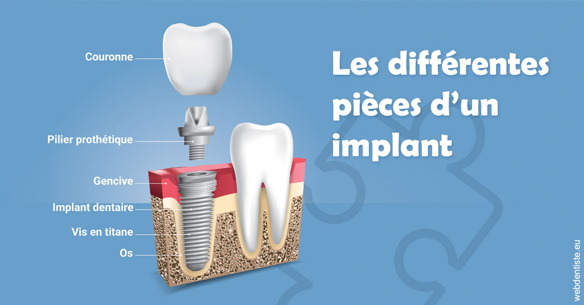 https://selarl-docteur-daniel-benichou.chirurgiens-dentistes.fr/Les différentes pièces d’un implant 1